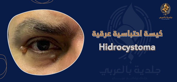 كيسة احتباسية عرقية (hidrocystoma) | هل تُعد ورم حميد أم خبيث؟