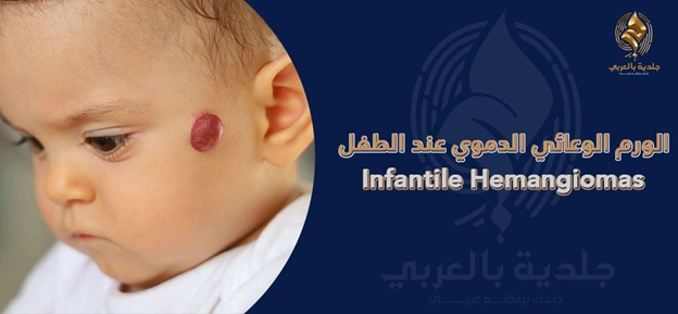 ماذا تفعل في حال تشخيص ورم وعائى دموي Hemangioma عند طفلك؟