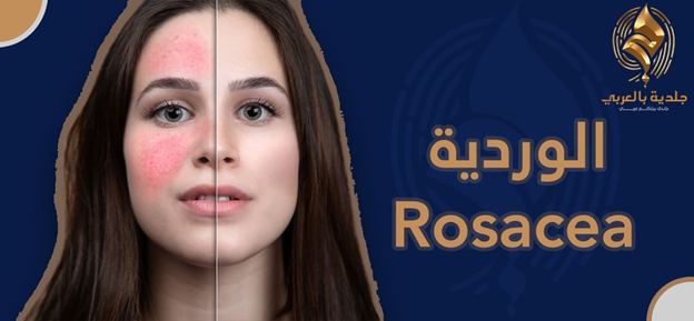 الفرق بين الوردية والحساسية | ما هى الوردية؟ وما كيفية التعامل معها؟