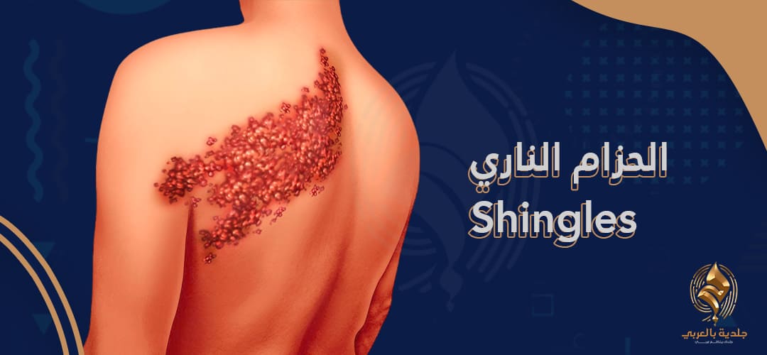 اكتشف بنفسك | هل الإجهاد النفسي من اسباب الحزام الناري؟