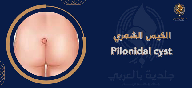 أعراض الناسور العصعصي | هل تصيب بالأكثر العاملين بالمكاتب؟