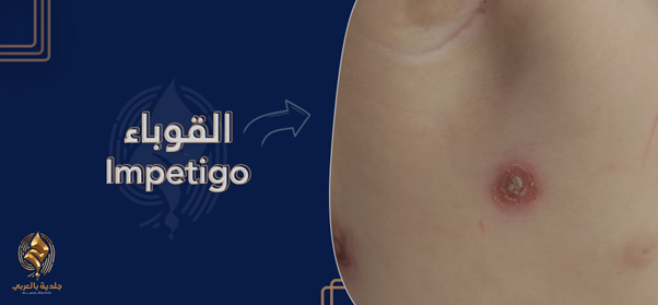 هل تعتقد أن طفلك مصاب بالقوباء؟ تعرف على شكل القوباء بالصور وطرق علاجها.
