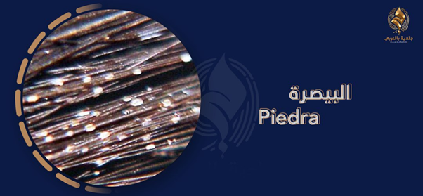علاج بيدرا الشعر في 3 خطوات وكيف يمكن التفرقة بينها وبين القمل؟
