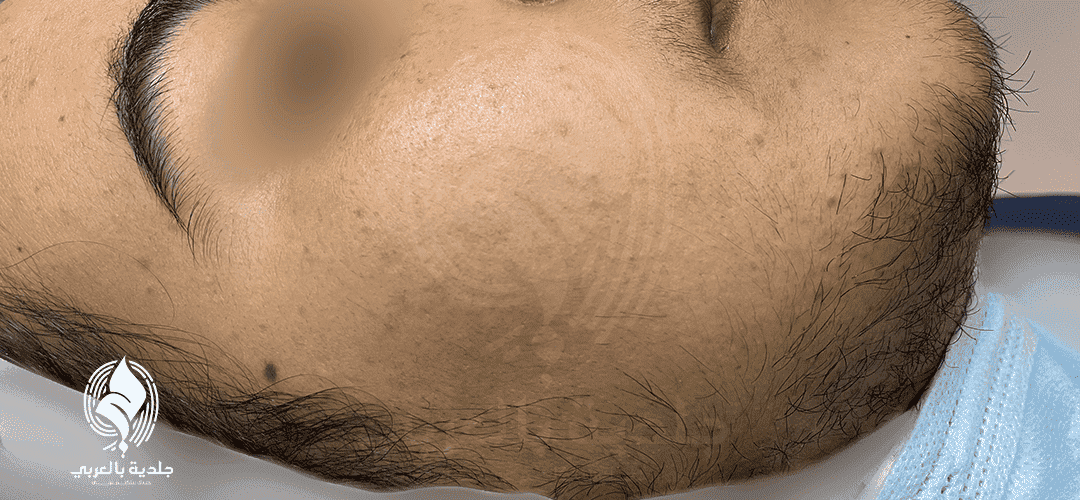أعراض الإصابة بالشعرانية Hirsutism