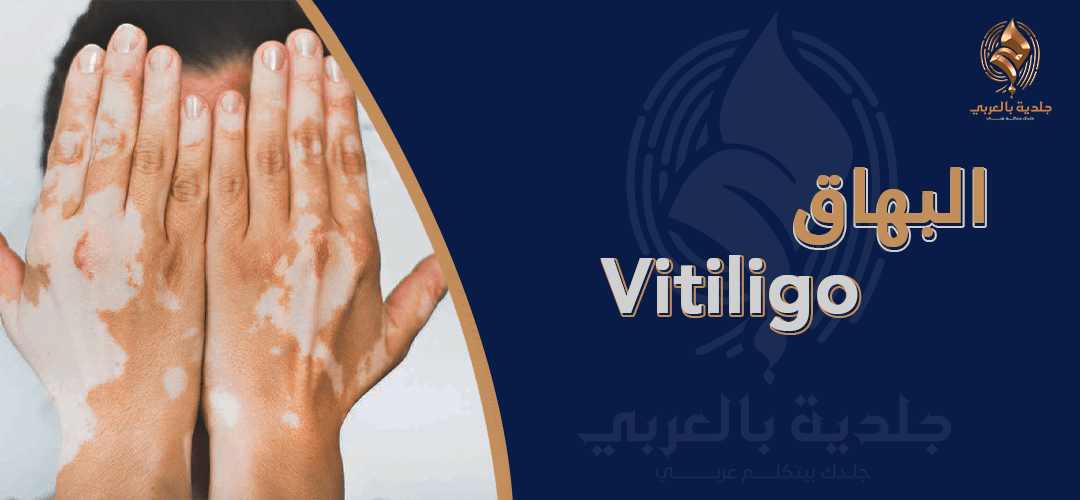 البهاق"vitiligo"| اعراضه عند الكبار وأصعب أنواع البهاق وكيفية التعايش