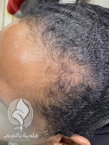 أنواع الصلع