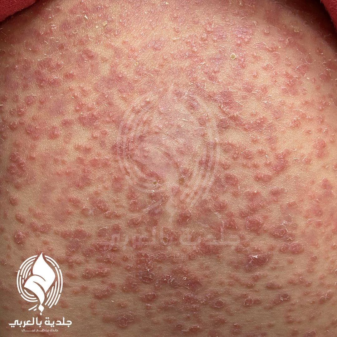 أعراض حمو النيل