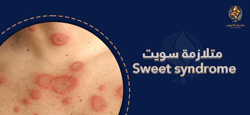 متلازمة سويت sweet syndrome | الأسباب وكيفية التشخيص وطرق العلاج