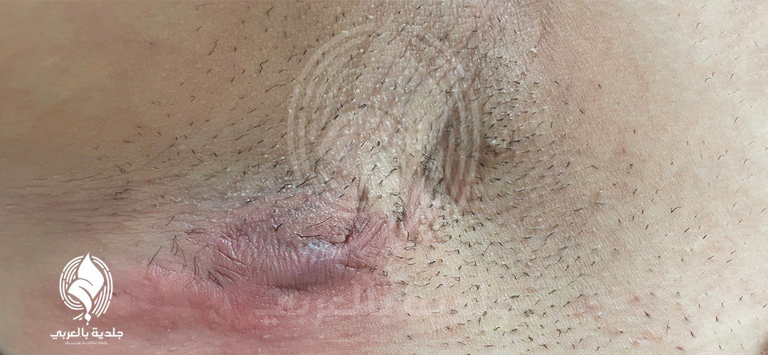 أعراض التهاب الغدد العرقية القيحي