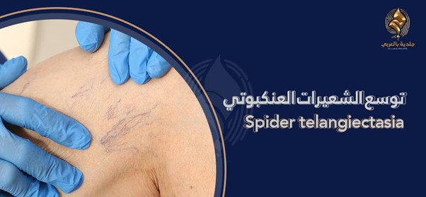 كل ما تحتاج معرفته عن علاج الأوردة العنكبوتية في الساقين وأسبابها