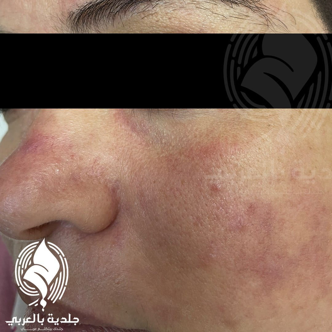 أعراض الوردية