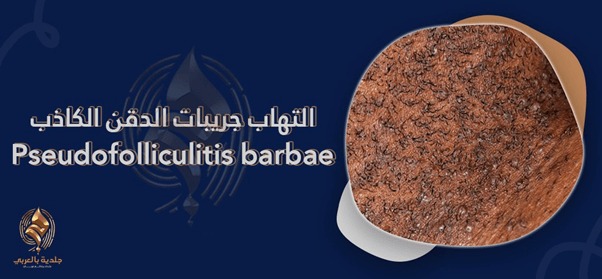 التهاب جريبات الذقن الكاذب Pseudofolliculitis barbae الأسباب وأساليب العلاج