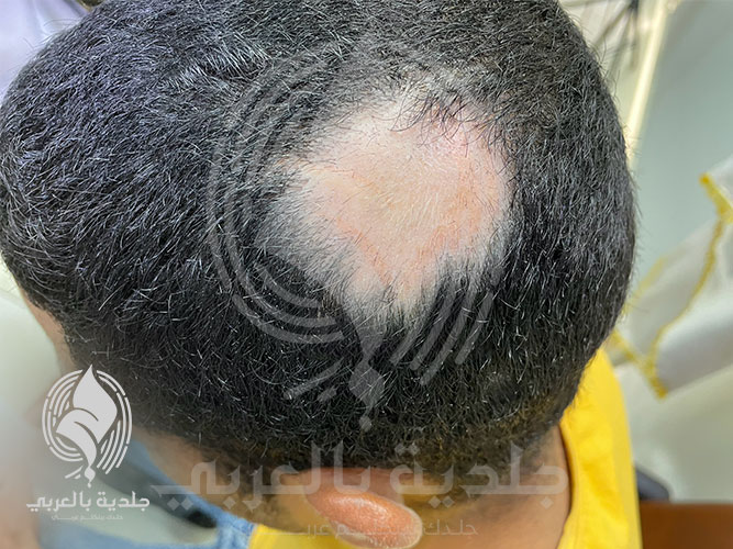 داء الثعلبة