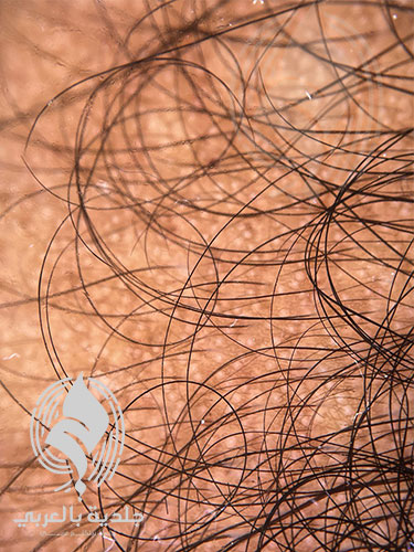 علاجات الصلع