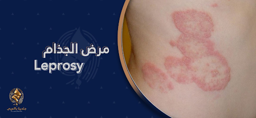 مرضٌ من العصور القديمة..اكتشف أشكال مرض الجُذام وطرق علاجه