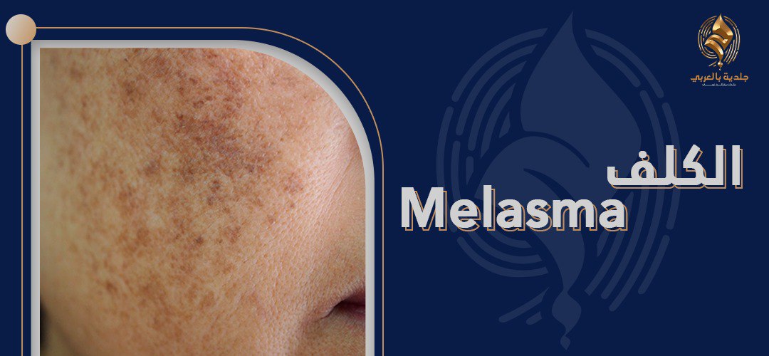 الكلف (Melasma)…ماهو؟ وما مسبباته؟ وما اسرع علاج للكلف؟
