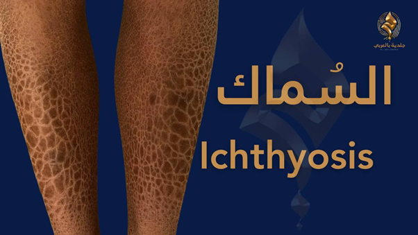 ما هو شكل مرض جلد السمكة بالصور؟ وهل يوجد له علاج؟