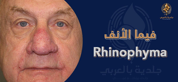 ما لا تعرفه عن فيمة الأنف (Rhinophyma)