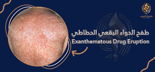 Exanthematous Drug Eruption الطفح الدوائي البقعى الحطاطي