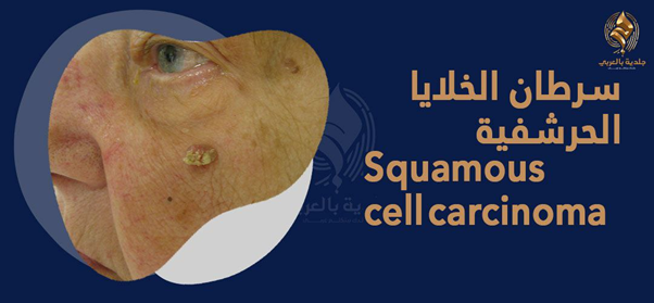 "سرطان الجلد الحرشفي" ما بين أنواعه وطرق علاجه!