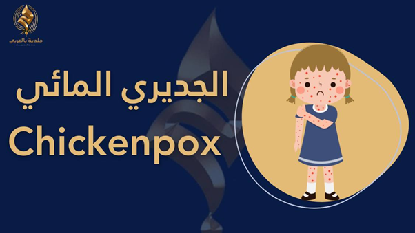 ليس للصغار فقط!.. ما يجب معرفته عن الجديري المائي للكبار