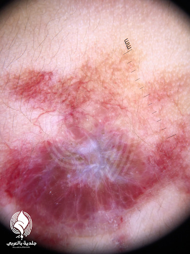 الورم الوعائي الدموي