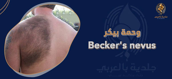 وحمة بيكر(becker nevus): الأسباب، الأعراض، والعلاج